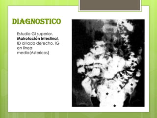 Estudio GI superior. Malrotación intestinal, ID al lado derecho, IG en línea media(Astericos) 
diagnostico  