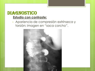 diagnostico 
Estudio con contraste: 
•Apariencia de compresión extrínseca y torsión: imagen en “saca corcho”.  