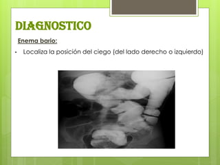 diagnostico 
Enema bario: 
•Localiza la posición del ciego (del lado derecho o izquierdo) 
 