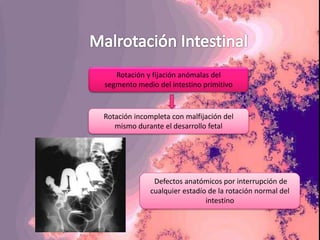 malrotacion-intestinal-cirugia-pediatrica-pptx