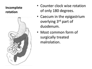 Incomplete
rotation
• Counter clock wise rotation
of only 180 degrees.
• Caecum in the epigastrium
overlying 3rd part of
duodenum.
• Most common form of
surgically treated
malrolation.
 