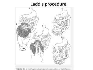 Ladd's procedure
 
