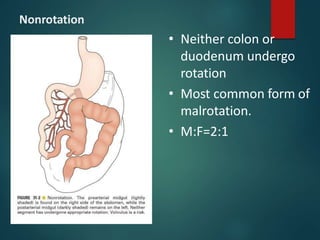 Nonrotation
• Neither colon or
duodenum undergo
rotation
• Most common form of
malrotation.
• M:F=2:1
 