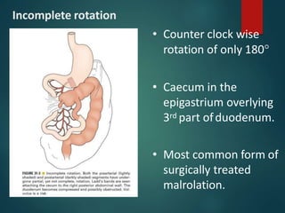 Incomplete rotation
• Counter clock wise
rotation of only 180
• Caecum in the
epigastrium overlying
3rd part ofduodenum.
• Most common form of
surgically treated
malrolation.
 
