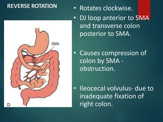 REVERSE ROTATION • Rotates clockwise.
• DJ loop anterior to SMA
and transverse colon
posterior to SMA.
• Causes compression of
colon by SMA -
obstruction.
• Ileocecal volvulus- due to
inadequate fixation of
right colon.
 