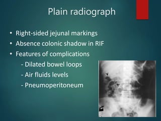 Plain radiograph
• Right-sided jejunal markings
• Absence colonic shadow in RIF
• Features of complications
- Dilated bowel loops
- Air fluids levels
- Pneumoperitoneum
 