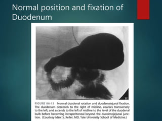 Normal position and fixation of
Duodenum
 