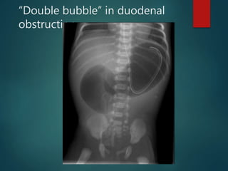 “Double bubble” in duodenal
obstruction
 