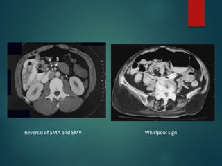 Reversal of SMA and SMV Whirlpool sign
 