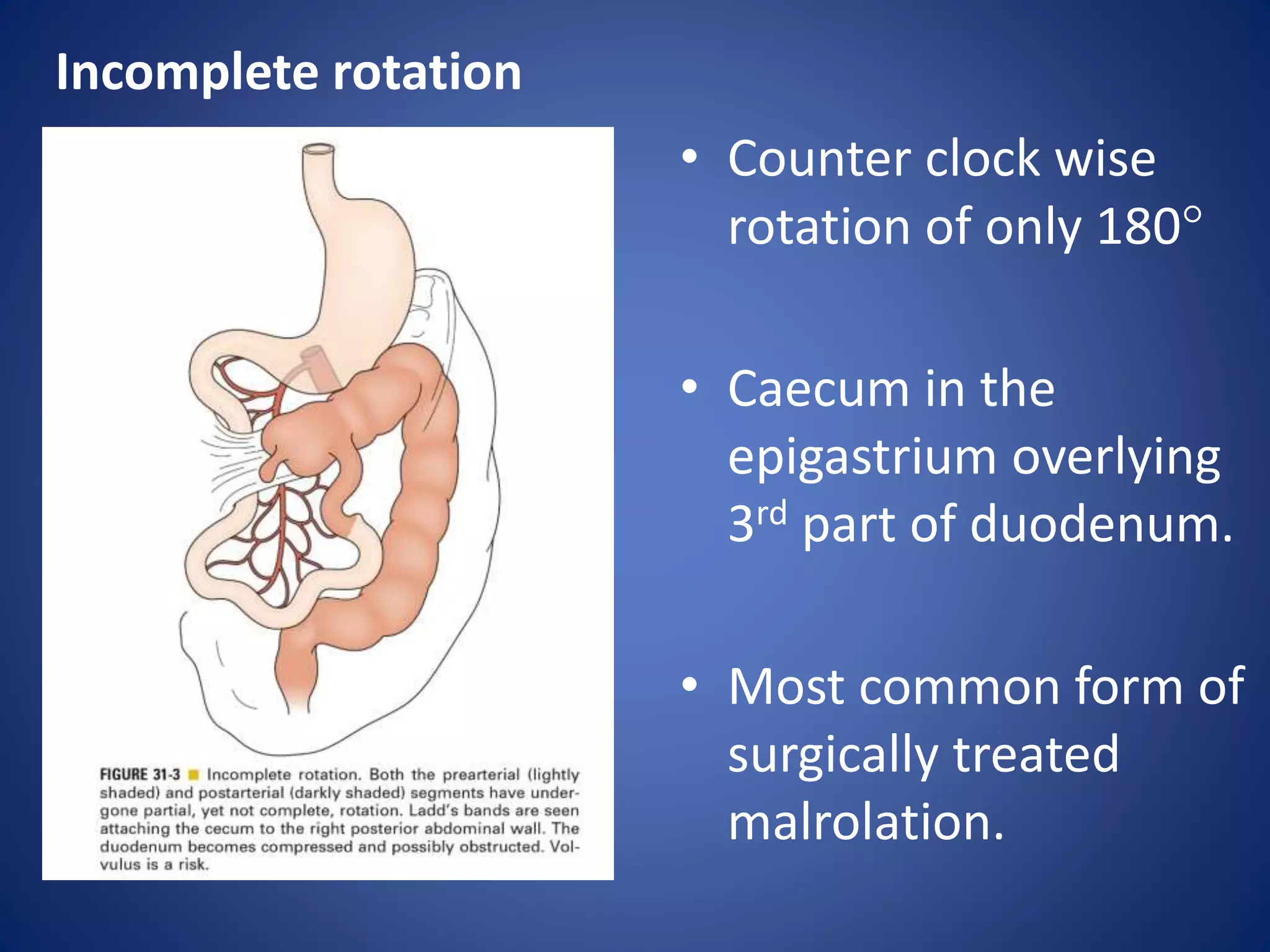Reverse Rotation Intestine Malrotation of gut | PPTX