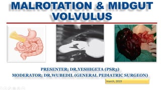 MALROTATION & MIDGUT
VOLVULUS
PRESENTER; DR.YESHIGETA (PSR3)
MODERATOR; DR.WUBEDIL (GENERAL PEDIATRIC SURGEON)
march, 2019
 