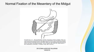 Malrotation with midgut volvulus.pptx