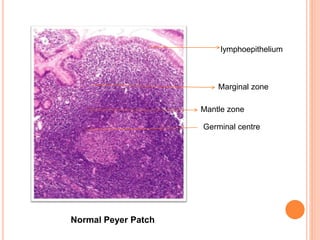 Germinal centre
Mantle zone
Marginal zone
lymphoepithelium
Normal Peyer Patch
 
