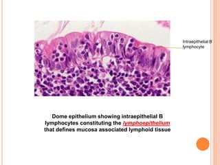 Dome epithelium showing intraepithelial B
lymphocytes constituting the lymphoepithelium
that defines mucosa associated lymphoid tissue
Intraepithelial B
lymphocyte
 