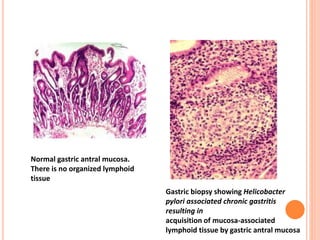 Gastric biopsy showing Helicobacter
pylori associated chronic gastritis
resulting in
acquisition of mucosa-associated
lymphoid tissue by gastric antral mucosa
Normal gastric antral mucosa.
There is no organized lymphoid
tissue
 