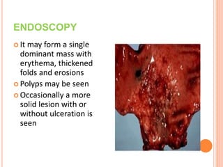 ENDOSCOPY
 It may form a single
dominant mass with
erythema, thickened
folds and erosions
 Polyps may be seen
 Occasionally a more
solid lesion with or
without ulceration is
seen
 