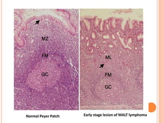 x
Normal Peyer Patch Early stage lesion of MALT lymphoma
 
