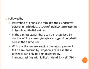  Followed by
 Infiltration of neoplastic cells into the gland/crypt
epithelium with destruction of architecture resulting
in lymphoepithelial lesions.
 In the earliest stages these can be recognised by
clusters of 3 or more cytologically atypical neoplastic
cells in the epithelium.
 With the disease progression the intact lymphoid
follicle are overrun by lymphoma cells and there
presence can only be demonstrated by
immunostatining with follicular dendritic cells(FDC).
 