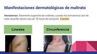 Manifestaciones dermatológicas de maltrato
Hematomas: Altamente sugerente de maltrato, cuando los hematomas son de
color amarillo tienen más de 18 horas de evolución. Espalda
Lineales Circunferencia
 