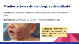 Contusiones: Representan la forma más frecuente de lesión en el maltrato
infantil.
Quemaduras: Constituyen 6 a 20% de todos los maltratos físicos
Manifestaciones dermatológicas de maltrato
Diagnóstico diferencial de
maltrato con púrpura por
defecto del factor XII de la
coagulación.
 