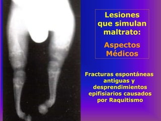 Lesiones
que simulan
maltrato:
Aspectos
Médicos
Fracturas espontáneas
antiguas y
desprendimientos
epifisiarios causados
por Raquitismo
 