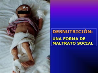 DESNUTRICIÓN:
UNA FORMA DE
MALTRATO SOCIAL
 