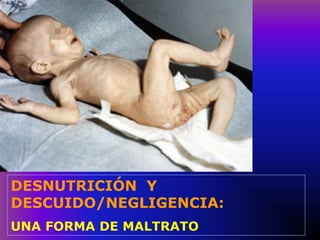 DESNUTRICIÓN Y
DESCUIDO/NEGLIGENCIA:
UNA FORMA DE MALTRATO
 