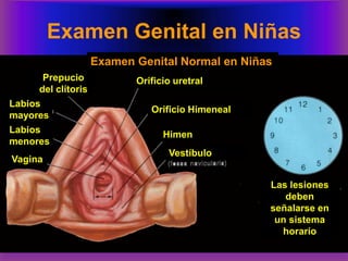 Examen Genital en Niñas
Examen Genital Normal en Niñas
Prepucio
del clítoris
Labios
mayores
Labios
menores
Vagina
Orificio uretral
Orificio Himeneal
Himen
Vestíbulo
Las lesiones
deben
señalarse en
un sistema
horario
 