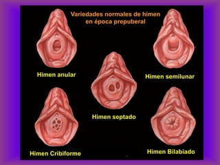Variedades normales de himen
en época prepuberal
Himen anular Himen semilunar
Himen septado
Himen Cribiforme Himen Bilabiado
 