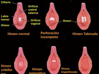 Clítoris
Labio
menor
Orificio
uretral
externo
Orificio
vaginal
Himen
Himen normal Perforación
incompleta
Himen
Himen Tabicado
Himen
cribifor Himen Himen
Imperforado
 