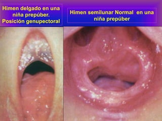 Himen semilunar Normal en una
niña prepúber
Himen delgado en una
niña prepúber.
Posición genupectoral
 