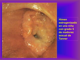 Himen
estrogenizado
en una niña
con grado 5
de madurez
sexual de
Tanner
 