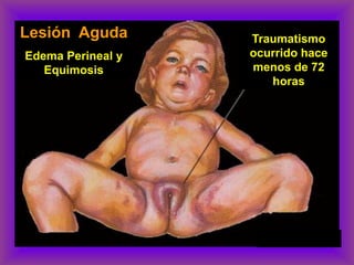 Lesión Aguda
Edema Perineal y
Equimosis
Traumatismo
ocurrido hace
menos de 72
horas
 