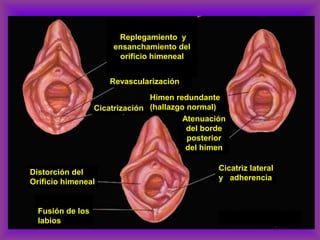 Replegamiento y
ensanchamiento del
orificio himeneal
Revascularización
Cicatrización
Himen redundante
(hallazgo normal)
Atenuación
del borde
posterior
del himen
Distorción del
Orificio himeneal
Fusión de los
labios
Cicatriz lateral
y adherencia
 