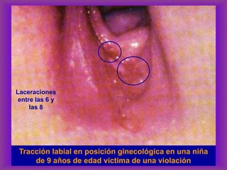 Tracción labial en posición ginecológica en una niña
de 9 años de edad víctima de una violación
Laceraciones
entre las 6 y
las 8
 