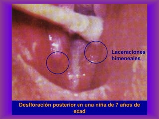 Desfloración posterior en una niña de 7 años de
edad
Laceraciones
himeneales
 