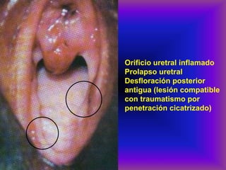 Orificio uretral inflamado
Prolapso uretral
Desfloración posterior
antigua (lesión compatible
con traumatismo por
penetración cicatrizado)
 