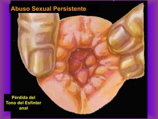 Abuso Sexual Persistente
Pérdida del
Tono del Esfínter
anal
 