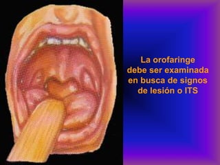 La orofaringe
debe ser examinada
en busca de signos
de lesión o ITS
 