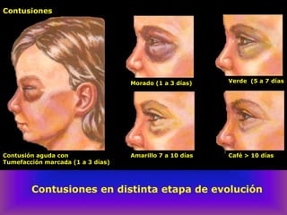 Contusiones
Contusión aguda con
Tumefacción marcada (1 a 3 días)
Morado (1 a 3 días) Verde (5 a 7 días
Amarillo 7 a 10 días Café > 10 días
Contusiones en distinta etapa de evolución
 