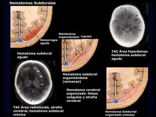 Hematomas Subdurales
TAC Área hiperdensa:
hematoma subdural
agudo
Hematoma subdural
agudo
Hemorragia
aguda
Membranas
organizándose
Hematoma subdural
organizándose
(semanas)
Hematoma Subdurtal
organizado (meses)
TAC Área radiolúcida, atrofia
cerebral, hematoma subdural
crónico
Hematoma cerebral
organizado: falsos
coágulos y atrofia
cerebral
Líquido
 