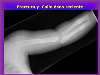 Fractura y Callo óseo reciente
 