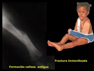 Formación callosa antigua
Fractura Inmovilizada
 