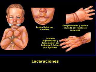 Laceraciones
Lesión típica por
mordaza
Enrojecimiento y edema
causado por ligaduras
recientes
Cambios
pigmentarios y
descamación por
lesiones Crónicas
por ligaduras
 