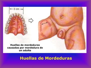 Huellas de mordeduras
causadas por mordedura de
un adulto
Huellas de Mordeduras
 