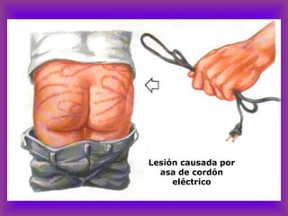 Lesión causada por
asa de cordón
eléctrico
 