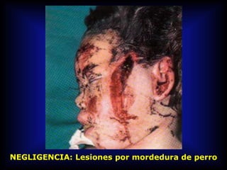 NEGLIGENCIA: Lesiones por mordedura de perro
 