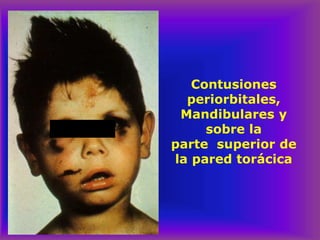 Contusiones
periorbitales,
Mandibulares y
sobre la
parte superior de
la pared torácica
 