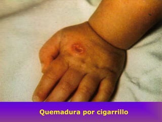 Quemadura por cigarrillo
 
