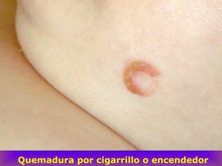 Quemadura por cigarrillo o encendedor
 